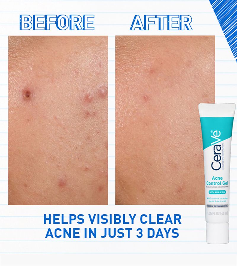 Acne Control Gel